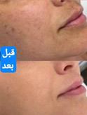 سرم ویتامین سی حاوی اسکوربیک اسید