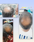 پک برکت رشد مژه و ابرو+ ضد ریزش مو+نرم کننده پوست و مو